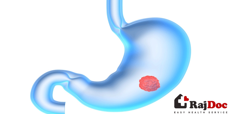 পাকস্থলীর ক্যান্সার এর কারন, উপসর্গ ও চিকিৎসা