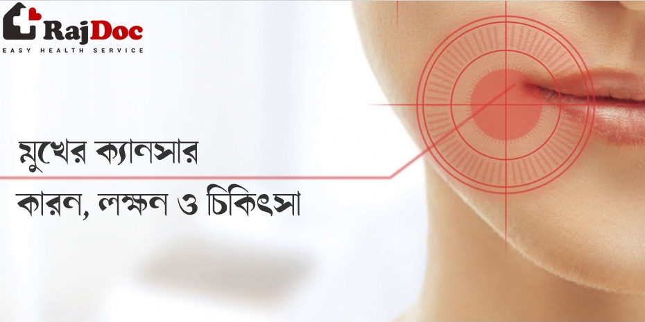 মুখের ক্যানসার (ওরাল ক্যান্সার ) এর কারন লক্ষন ও চিকিৎসা