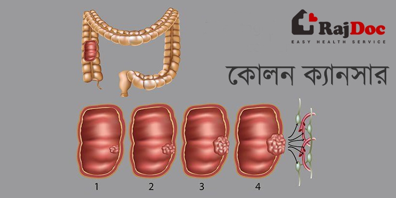 কোলন ক্যান্সার এর লক্ষন কারন ও চিকিৎসা
