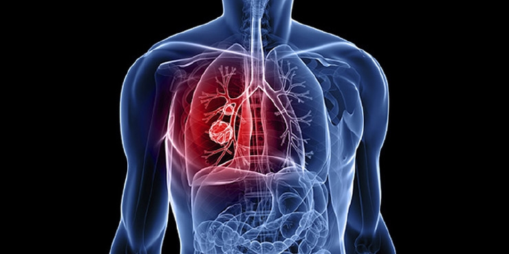 ফুসফুসে ক্যান্সার এর কারন, প্রকারভেদ, লক্ষন ও চিকিৎসা