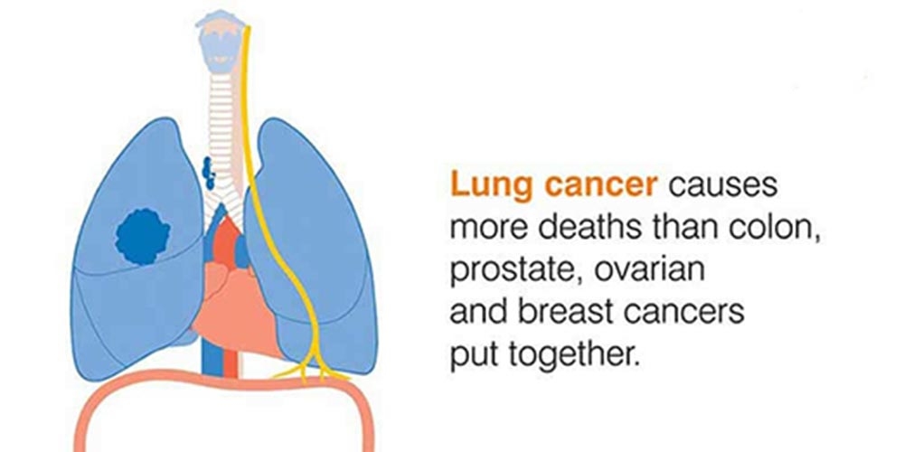 ফুসফুসে ক্যান্সারের  যেসকল কারণে মৃত্যুঝুঁকি সবচেয়ে বেশি থাকে