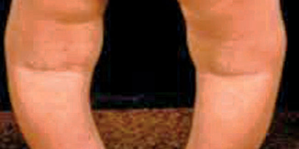 শিশুর রিকেটস রোগ : কেন হয়, হলে কী করা উচিত