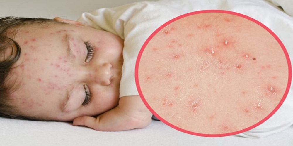 শিশুর জলবসন্তে করনীয়