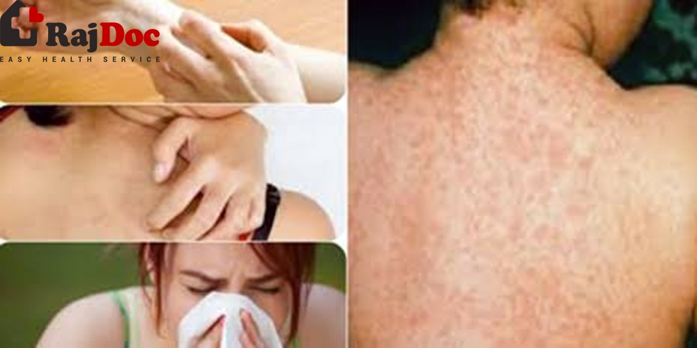 এলার্জির মৌলিক ধারণা - ডা: মুহা: আলমগীর রেজা এমবিবিএস, বিসিএস (স্বাস্থ্য) ডিডিভি (চর্ম ও যৌন রোগ) এমএসিপি (আমেরিকা)