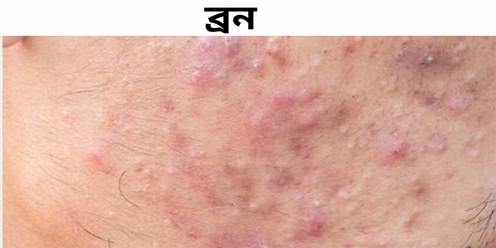 ব্রণ কেন হয়, হলে কী করবেন ?