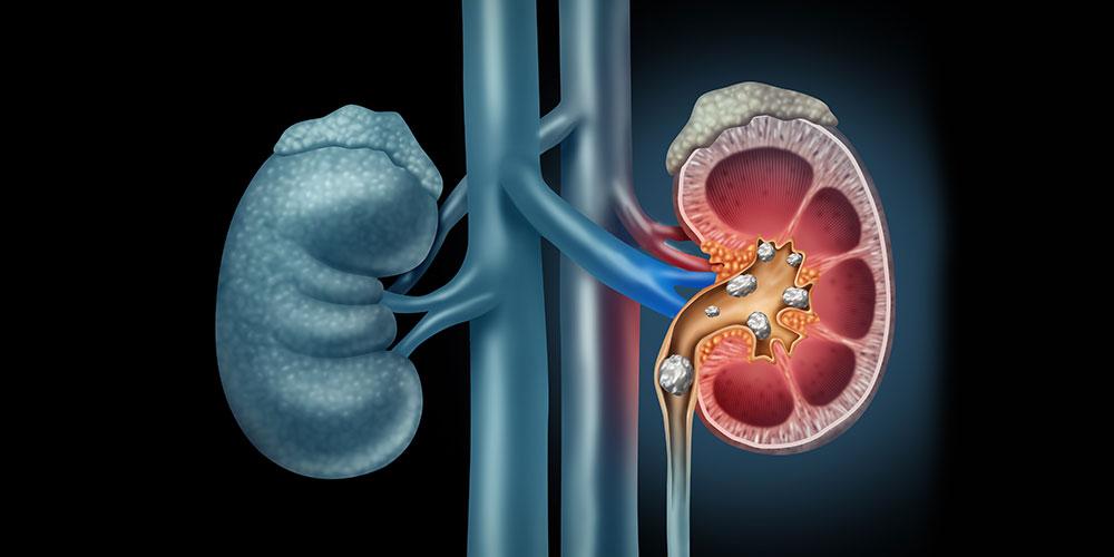 মেয়েদের কিডনি ও কিডনির নালির পাথর বেশি হওয়ার কারন?