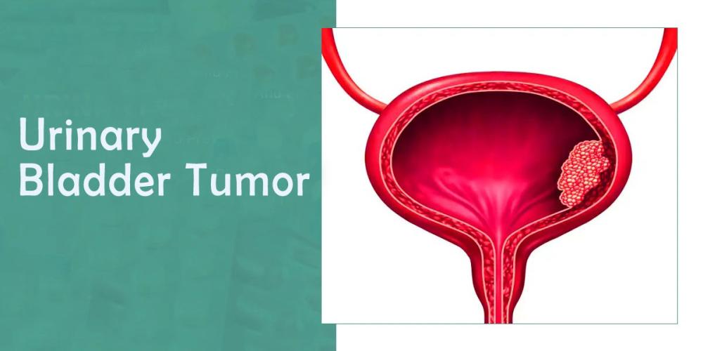 মূত্রথলির টিউমার (Urinary Bladder Tumor) কী?