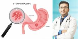 পাকস্থলীর পলিপ (Stomach Polyp): নীরব ঘাতক