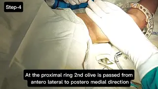 Cubitus valgus deformity correction by Ilizarov | Deformity Correction | Ilizarov in Humerus